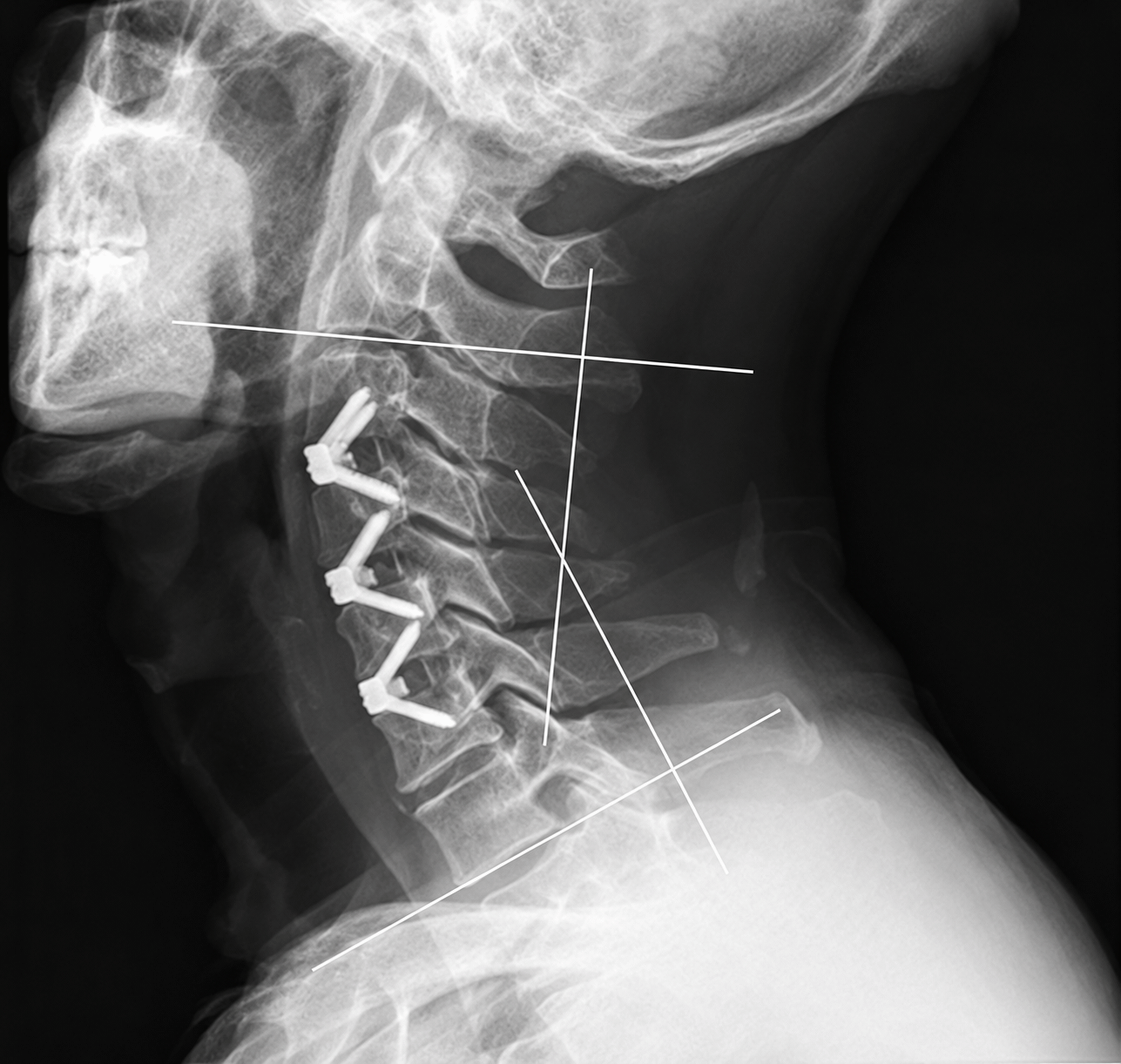 ACDF & Interbody Cages